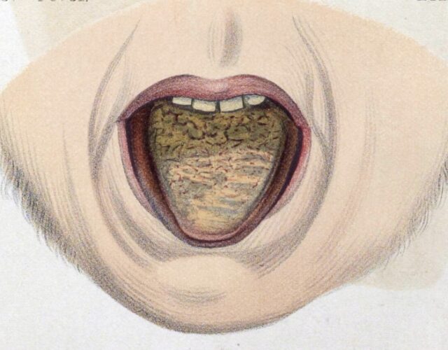 Color illustration of an open mouth showing a diseased tongue